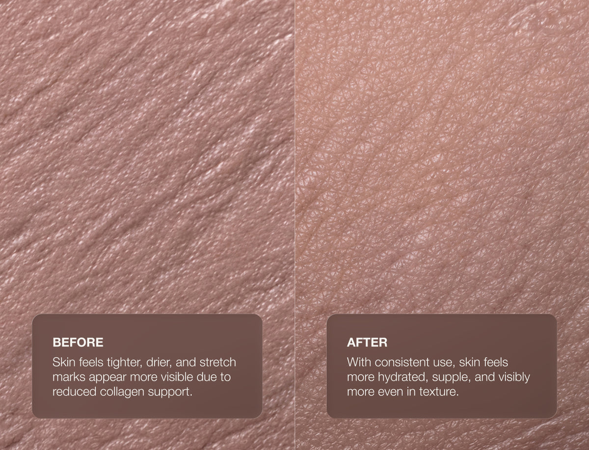 Anti-Stretch Mark Serum
